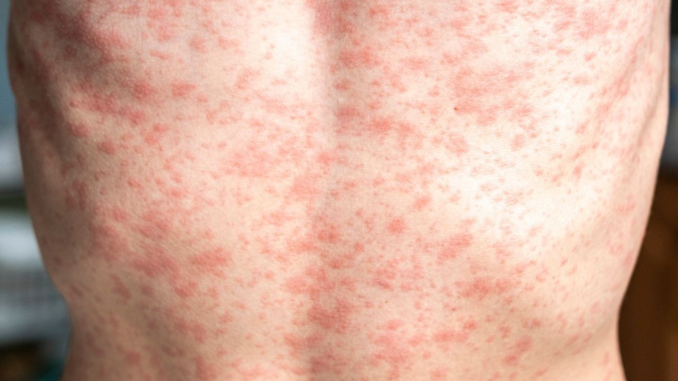 Clackamas County alerts about potential measles exposure at Kaiser Permanente Sunnyside Center