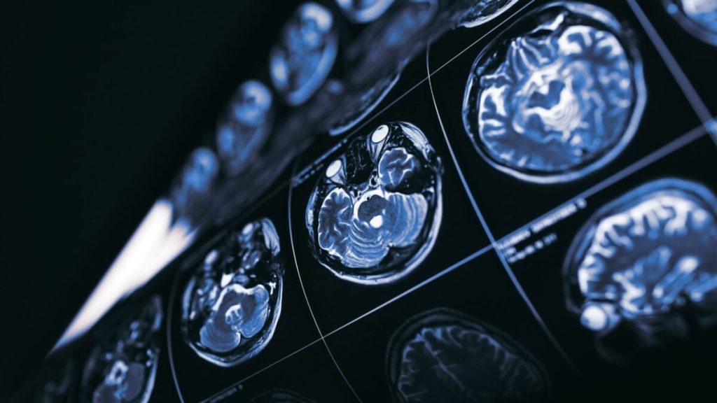 Could Cancer Be the Key to New Alzheimer's Treatments?