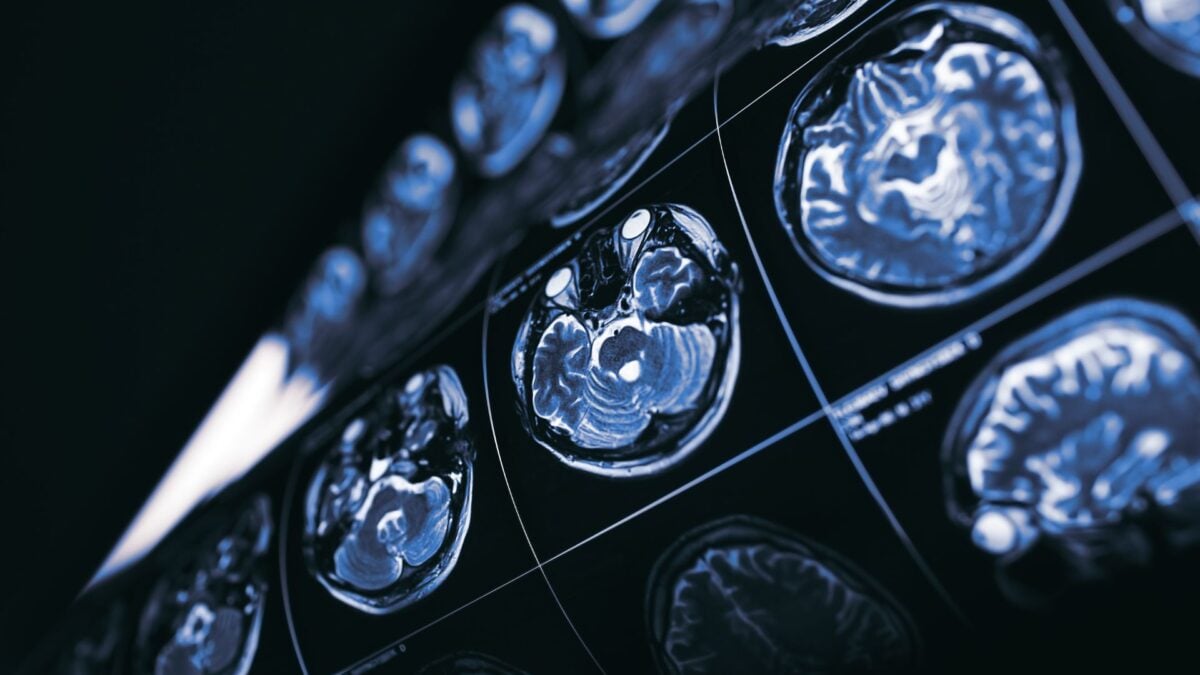 Could Cancer Be the Key to New Alzheimer's Treatments?