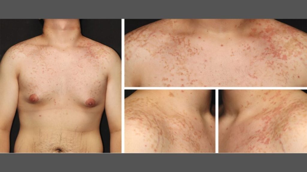 Man's Change to Keto Diet Causes Unusual, Rare Rash