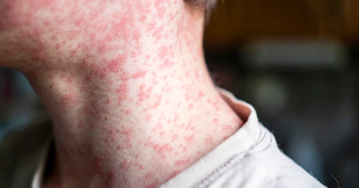 Measles cases increase in South Carolina as the U.S. faces the threat of losing its elimination status