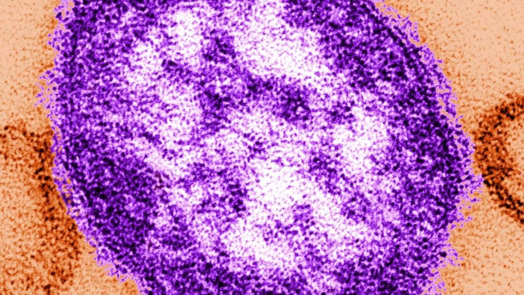 Measles outbreak confirmed in Snohomish County after three local children test positive.