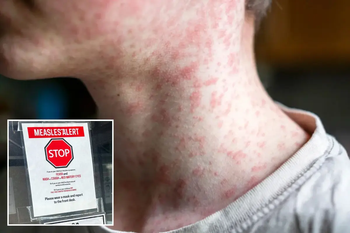 Measles outbreak in South Carolina surges past 200 cases, several hospitalized