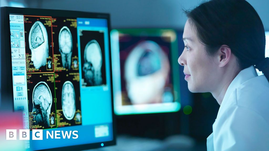 Menopause associated with brain changes similar to Alzheimer's