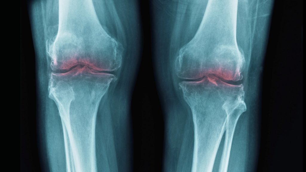 New Discovery to Revive Aging Joints May Aid in Osteoarthritis Treatment