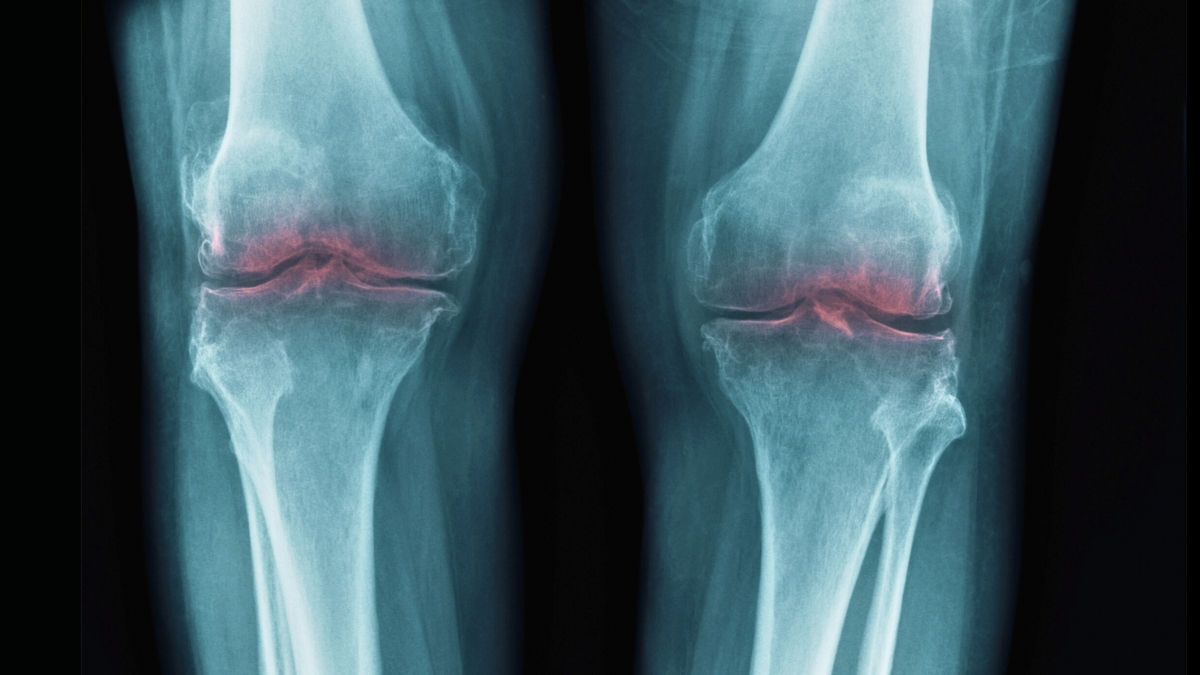 New Discovery to Revive Aging Joints May Aid in Osteoarthritis Treatment