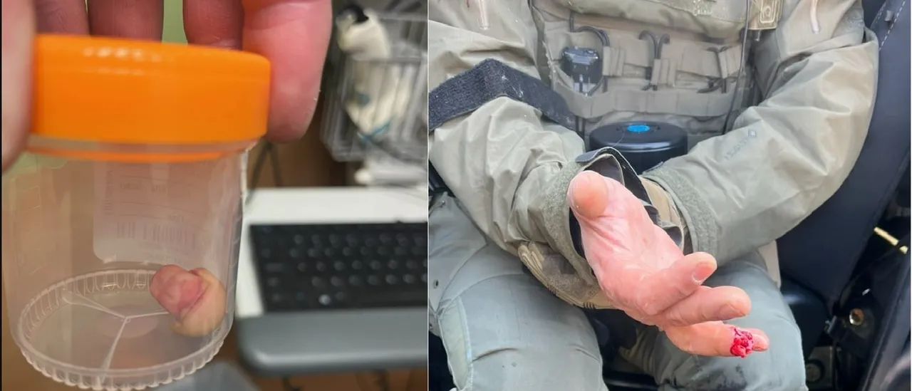 Protester Bites Off Federal Officer's Finger During Minneapolis Unrest