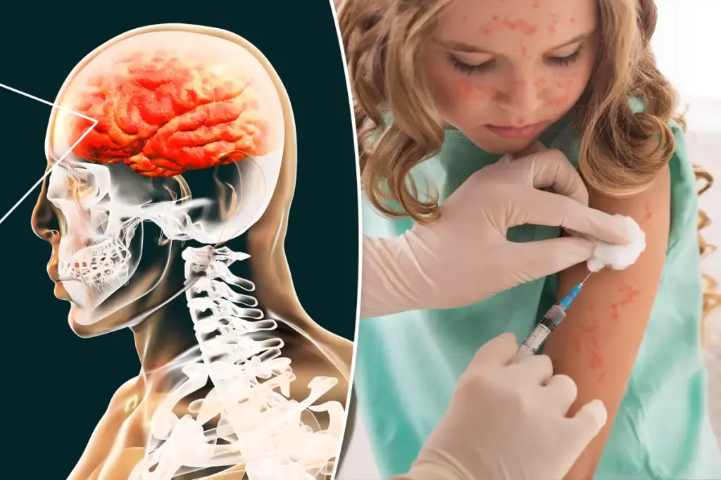 Severe measles complications can be fatal years later