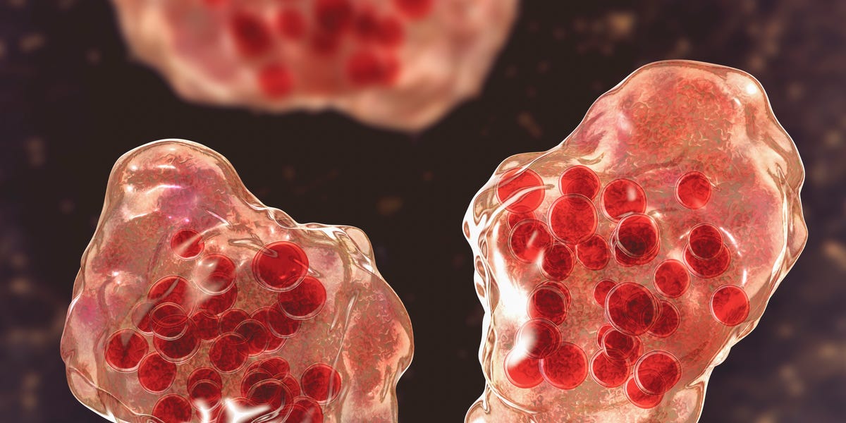 What Physicians Advise You to Do Following Measles Exposure