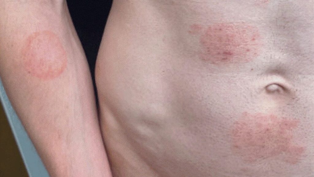 A Fungus Transmitted Through Sexual Activity Is Settling In the US