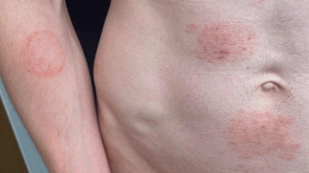 A Fungus Transmitted Through Sexual Activity Is Settling In the US