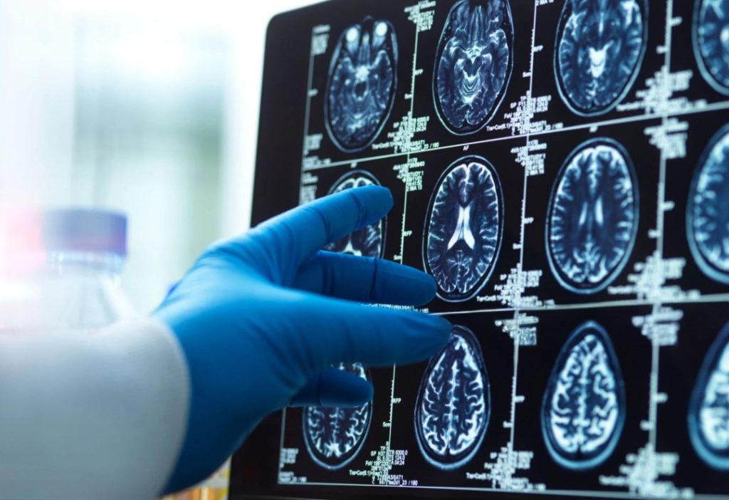 Alzheimer's Diagnosis at 57 Highlights the Importance of Early Action