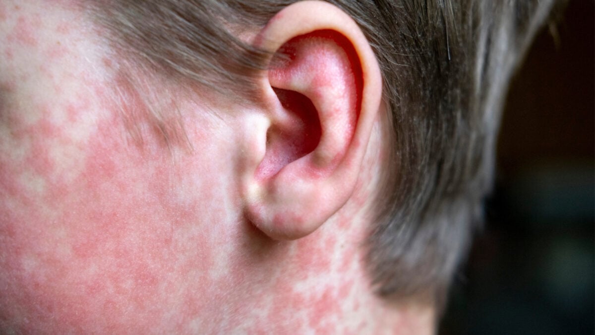 CDC Denies Responsibility for Measles Increasing Rapidly