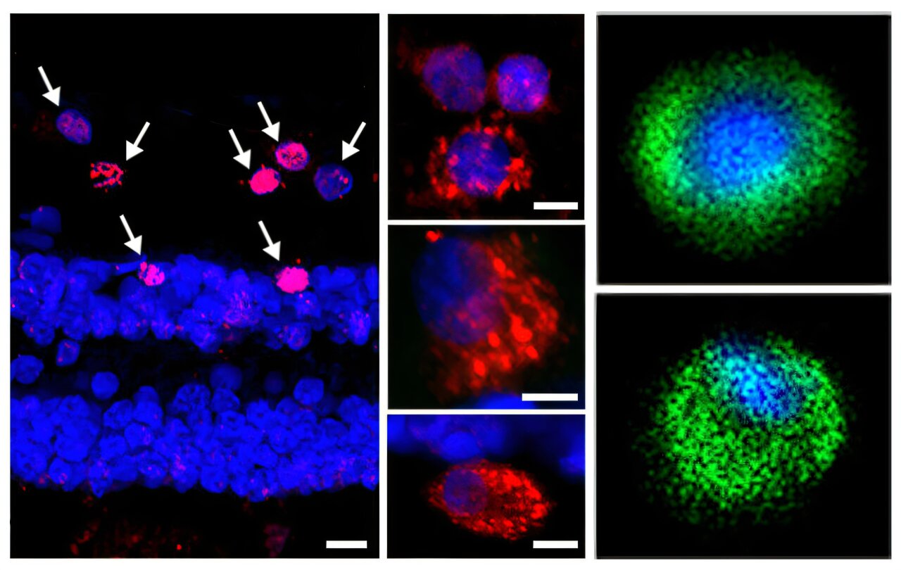 Common bacteria found in the eye associated with cognitive decline