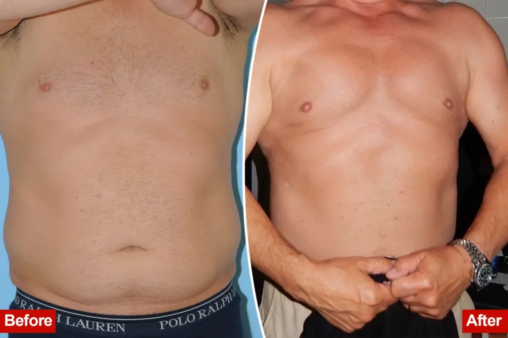 Discover the men enhancing their bodies through liposuction