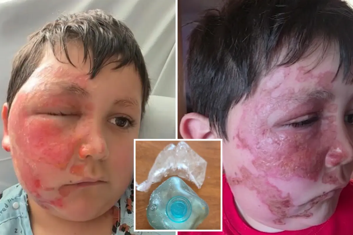 Illinois boy seriously injured from heating NeeDoh sensory toy in TikTok challenge