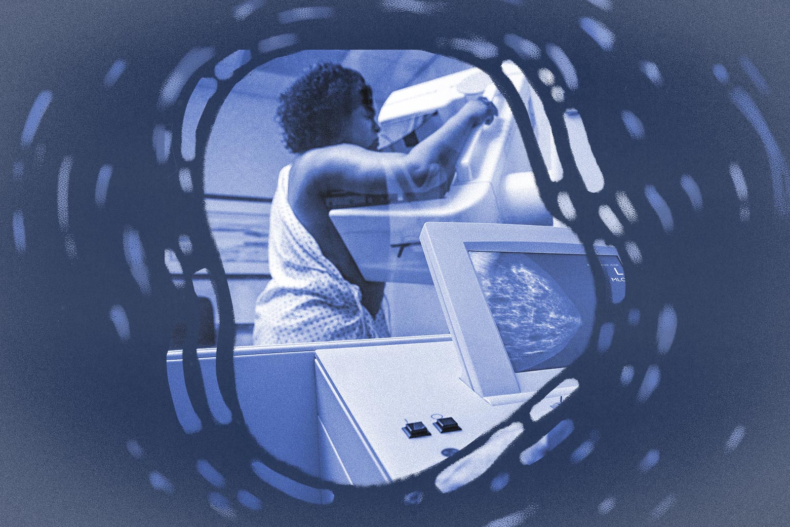 Mammograms are essential for detecting breast cancer, but they aren't effective for women like me.