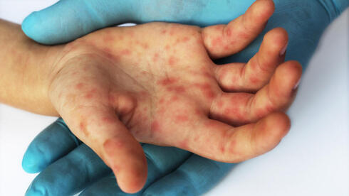 Non-vaccinated children taken out of Israeli preschools as measles outbreak escalates