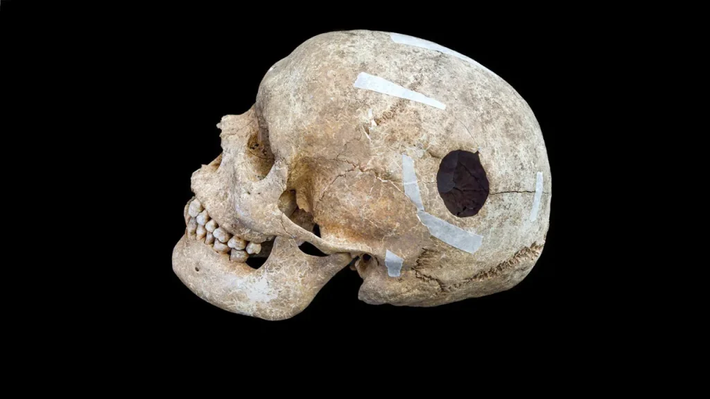 Proof of the earliest surgery discovered on a Viking-era man's skull