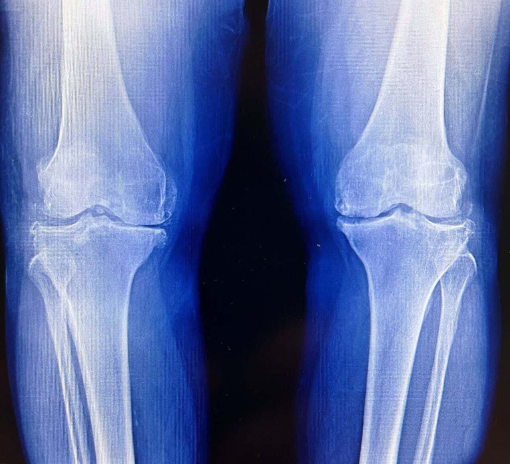 Researchers Discovered a Method to Regenerate Cartilage Without Stem Cells