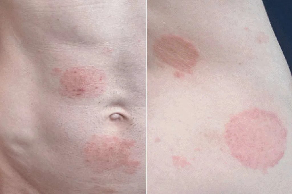 Ringworm Spreads in Minnesota in Its Largest Documented Outbreak