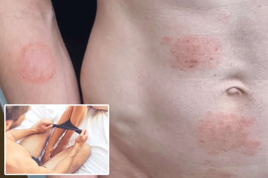 Spread of STI that leads to ringworm in undesirable areas