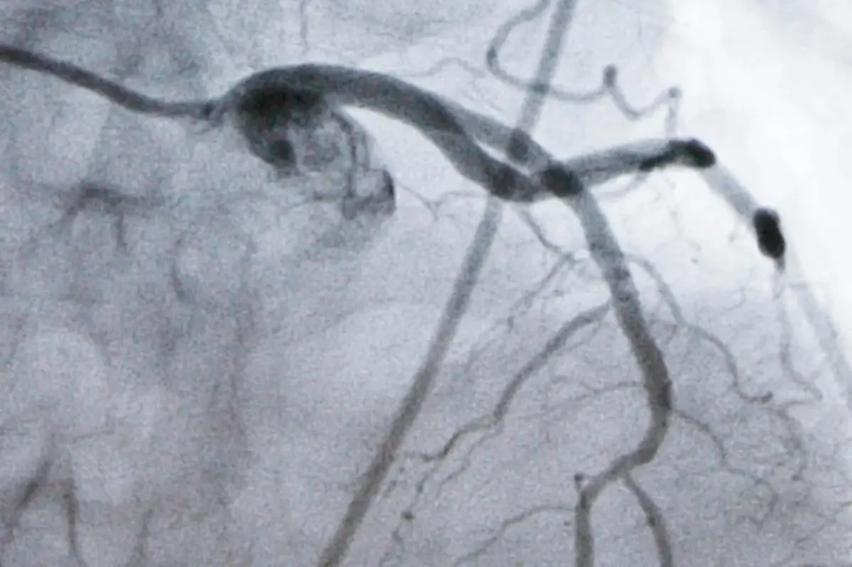 Study shows that a new cholesterol-lowering pill may provide millions with an alternative.