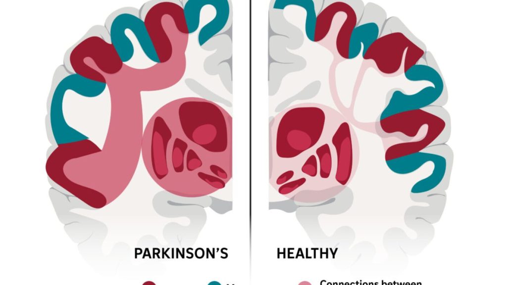 This intricate brain network might clarify some of Parkinson's unusual symptoms.
