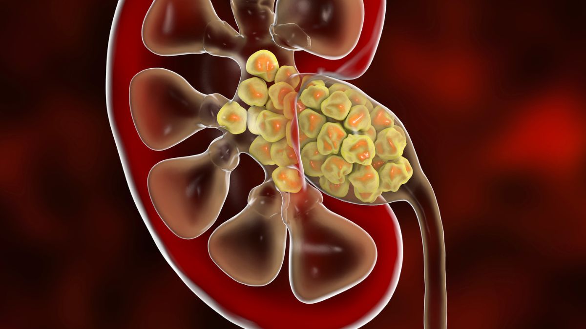 Unexpected Discovery in Kidney Stones Implies Our Understanding of Their Formation May Be Incorrect