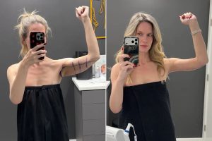 41-Year-Old Woman Fed Up with Concealing Loose Skin After Shedding 180 Pounds Through a GLP-1, Undergoes 'Awake' Arm Lift