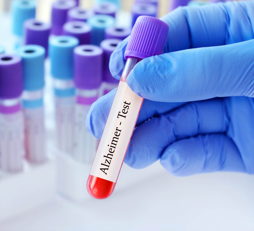 Blood test forecasts dementia 25 years ahead of symptoms showing up