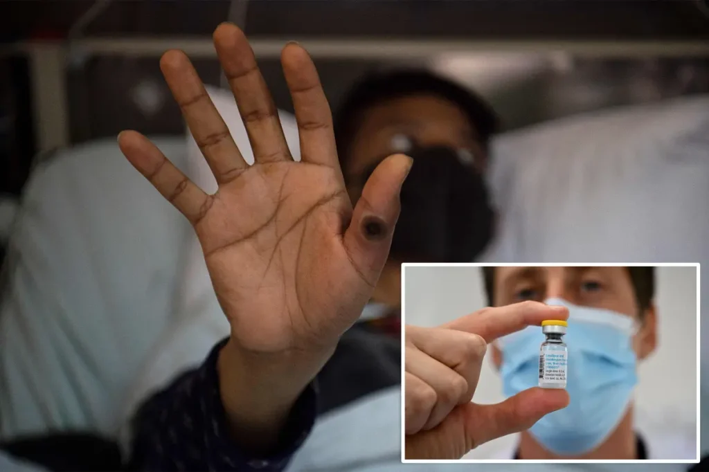 Severe strain of mpox virus identified for the first time in NYC