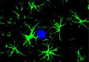 Study Reveals Immune Cells Target Alzheimer’s Plaques in Brain as VA Plans for Future Dementia Care