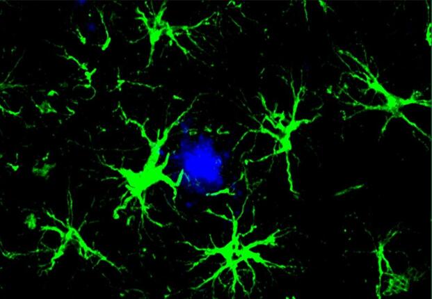 Study Reveals Immune Cells Target Alzheimer’s Plaques in Brain as VA Plans for Future Dementia Care