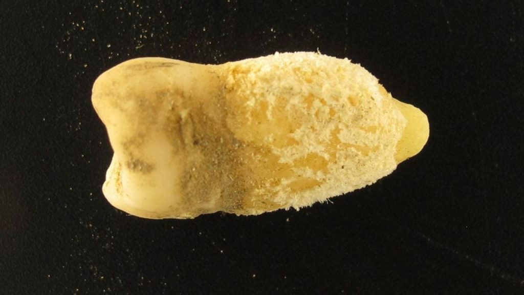 A Tooth from a Bolivian Mummy Is Changing Our Understanding of Scarlet Fever
