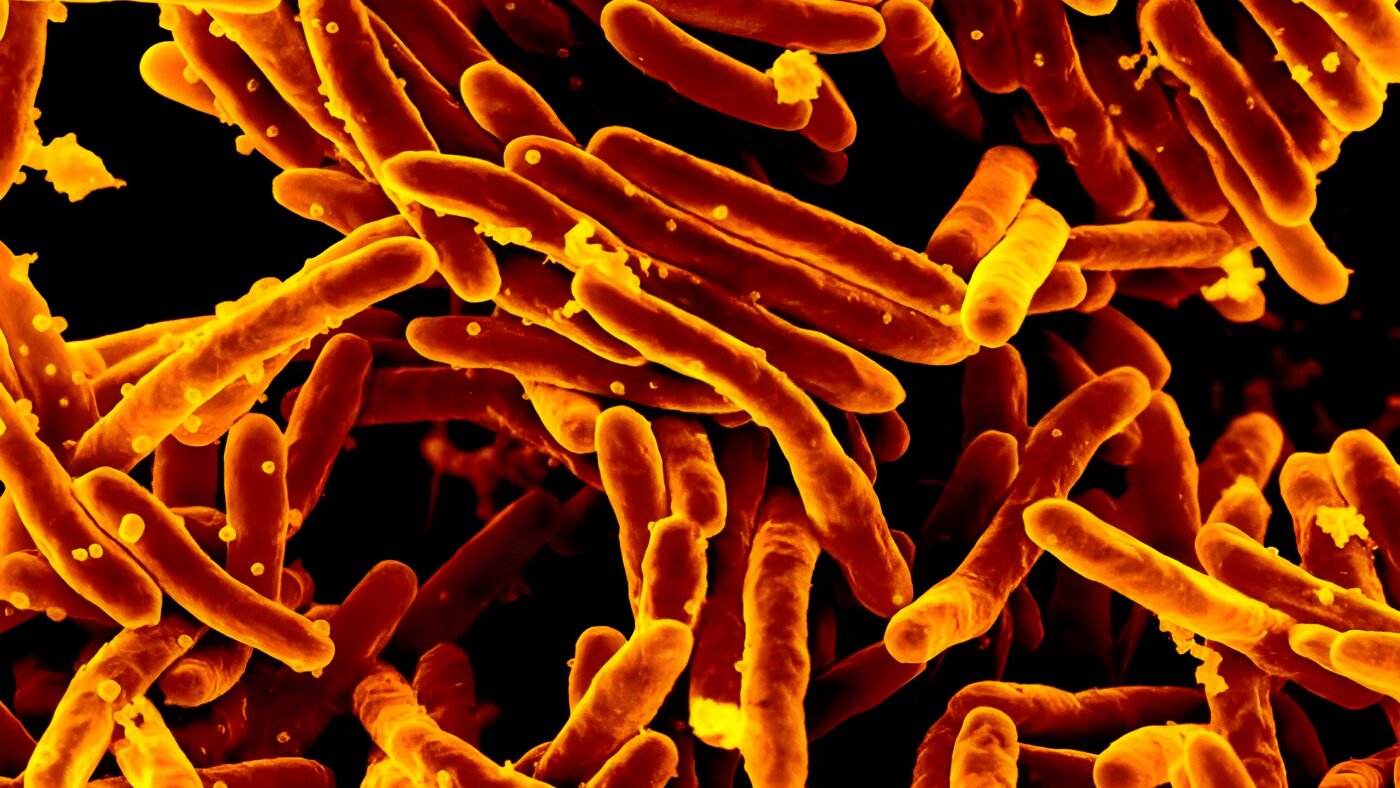 A quick and precise TB test that doesn't require sputum