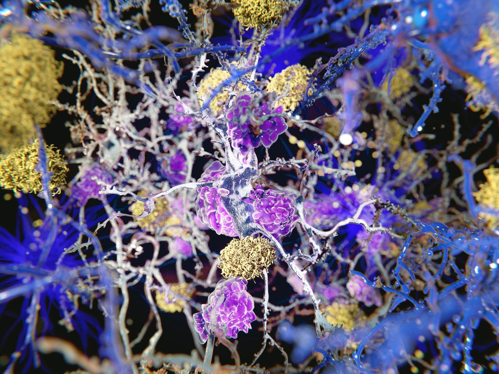 Alzheimer's could begin with inflammation in body tissues rather than in the brain.