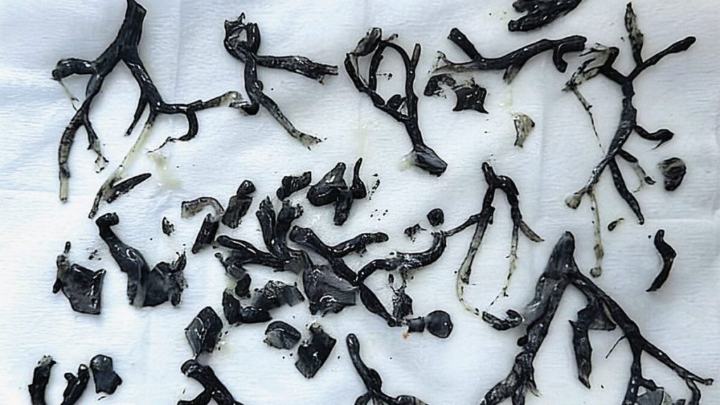 Black Substance Discovered in Man's Lungs Reveals a More Troubling Aspect of Wildfire Smoke