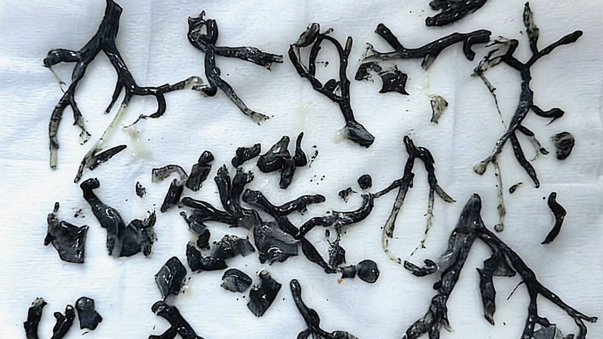 Black Substance Discovered in Man's Lungs Reveals a More Troubling Aspect of Wildfire Smoke