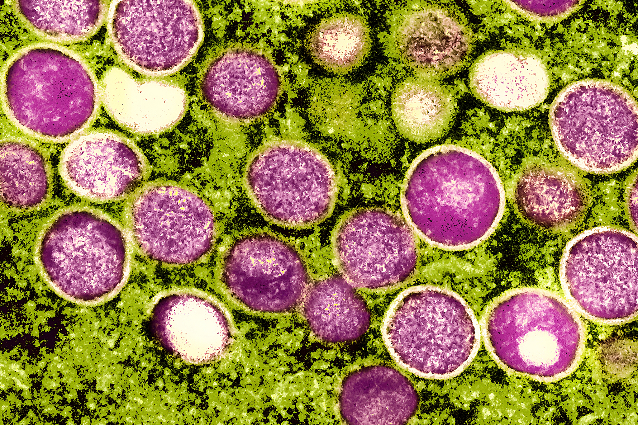 California officials express concern as the weekly average of uncommon viral cases increases