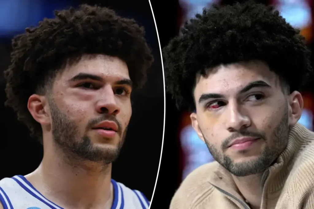 Cameron Boozer sustained several facial fractures during the defeat against UConn.