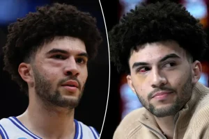 Cameron Boozer sustained several facial fractures during the defeat against UConn.