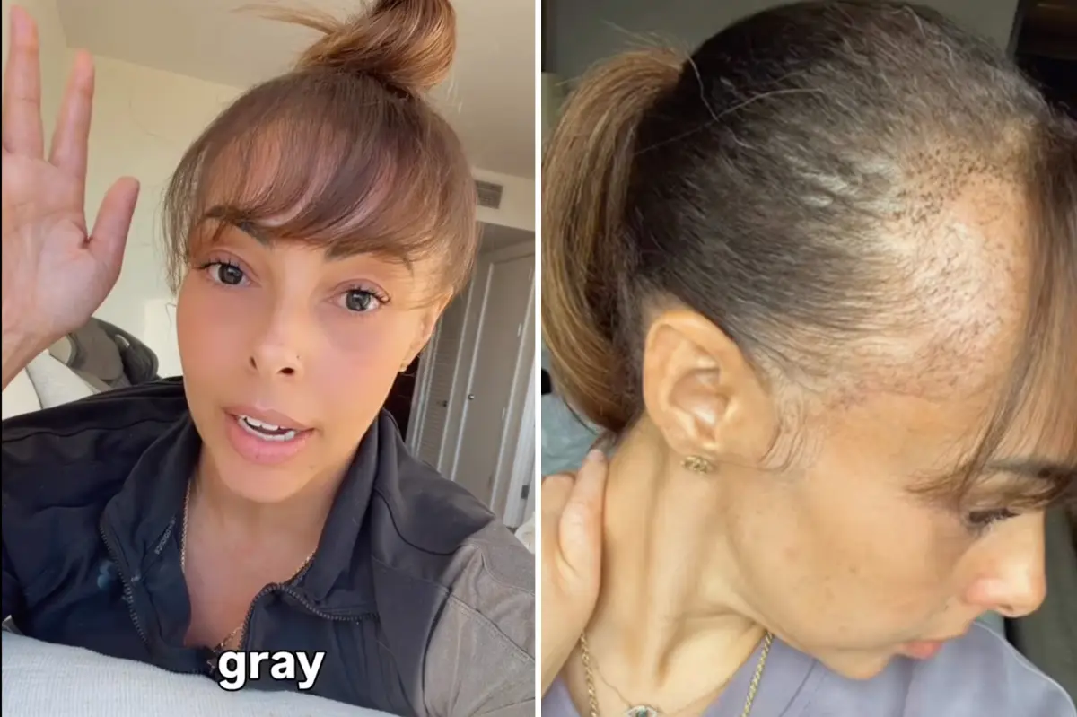 Hair transplant caused unusual side effect — doctor surprised: 'This has never occurred before'