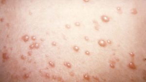 In an uncommon chickenpox situation, itchy blisters develop into large, rubbery lumps.