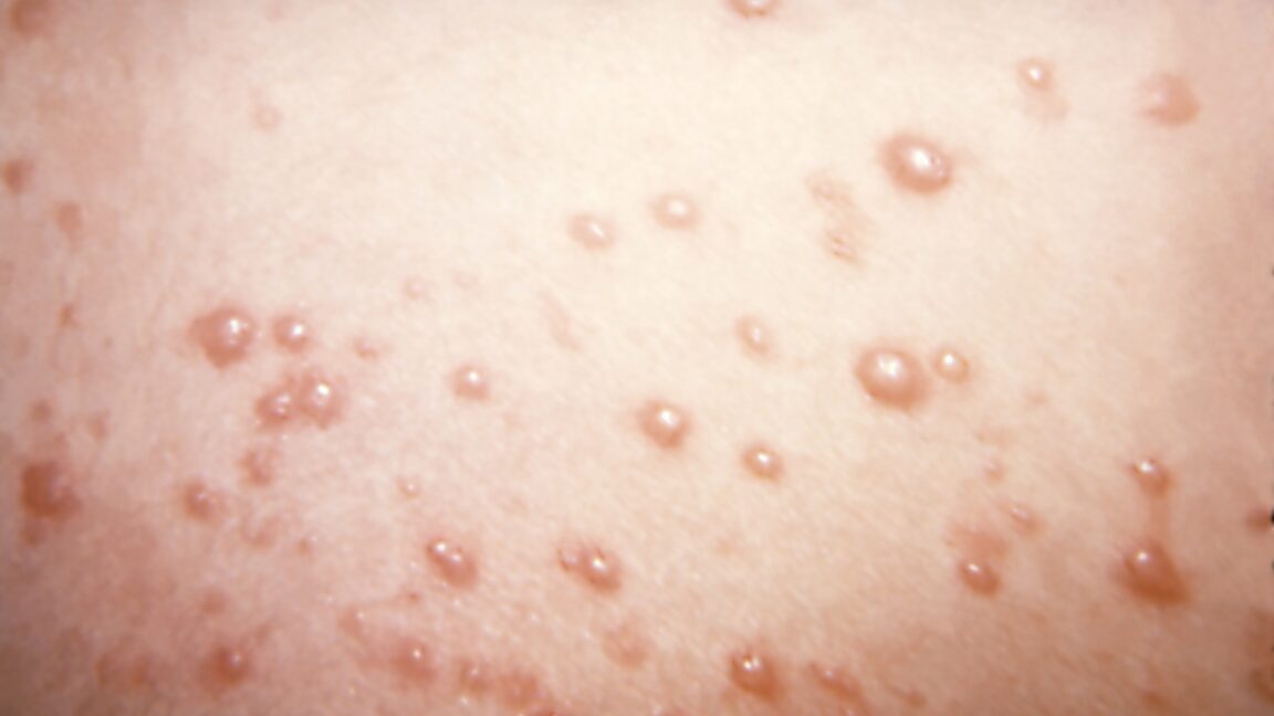 In an uncommon chickenpox situation, itchy blisters develop into large, rubbery lumps.