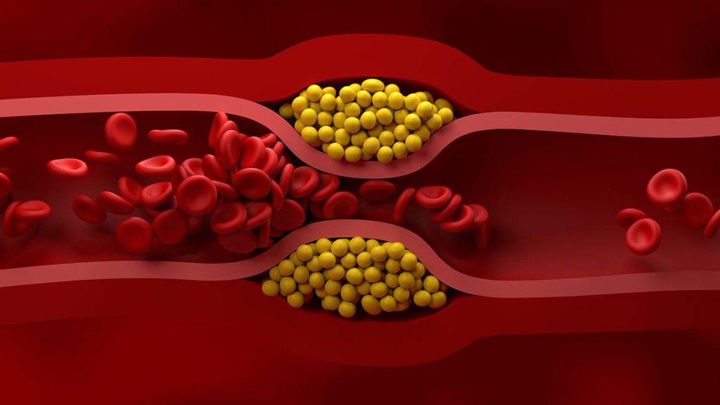 New Guidelines for Managing Cholesterol Released by US Cardiologists
