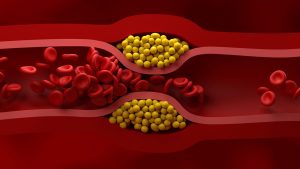 New Guidelines for Managing Cholesterol Released by US Cardiologists