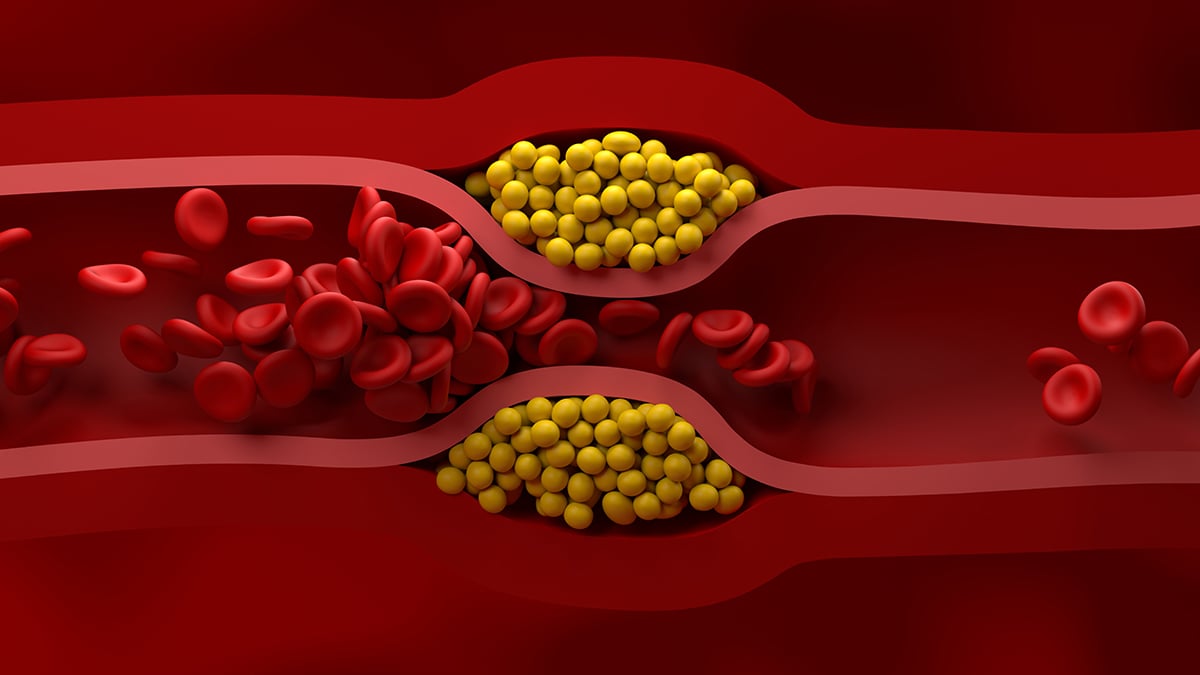 New Guidelines for Managing Cholesterol Released by US Cardiologists
