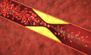 New Guidelines from US Cardiologists Could Change Cholesterol Prevention Indefinitely