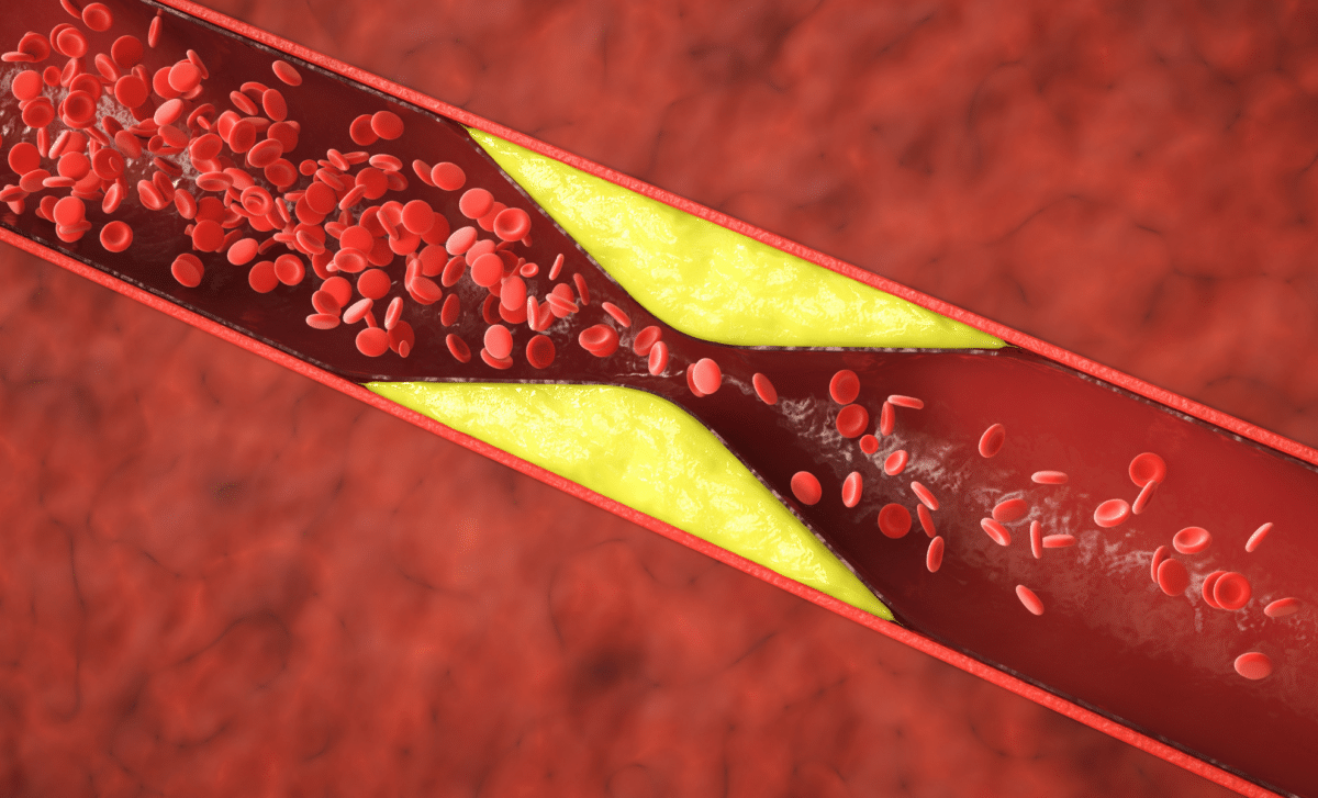 New Guidelines from US Cardiologists Could Change Cholesterol Prevention Indefinitely